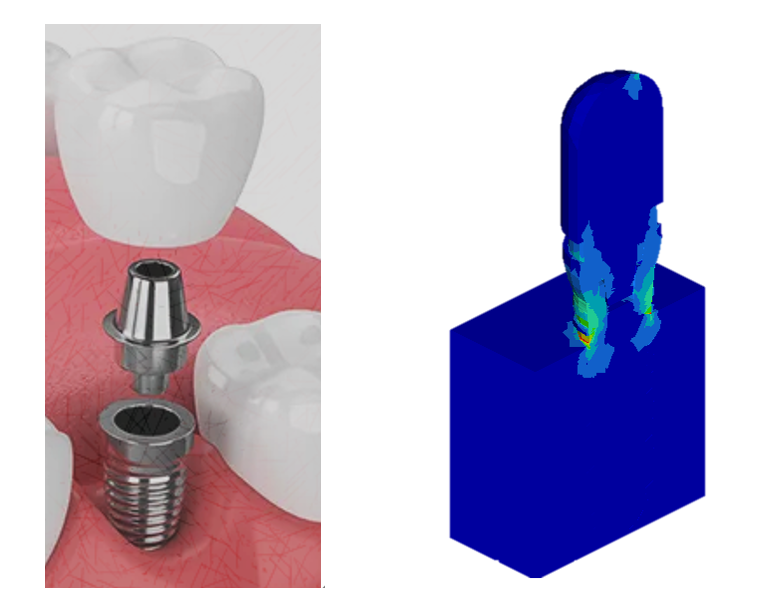 Bone screw structure CAE analysis results illustration